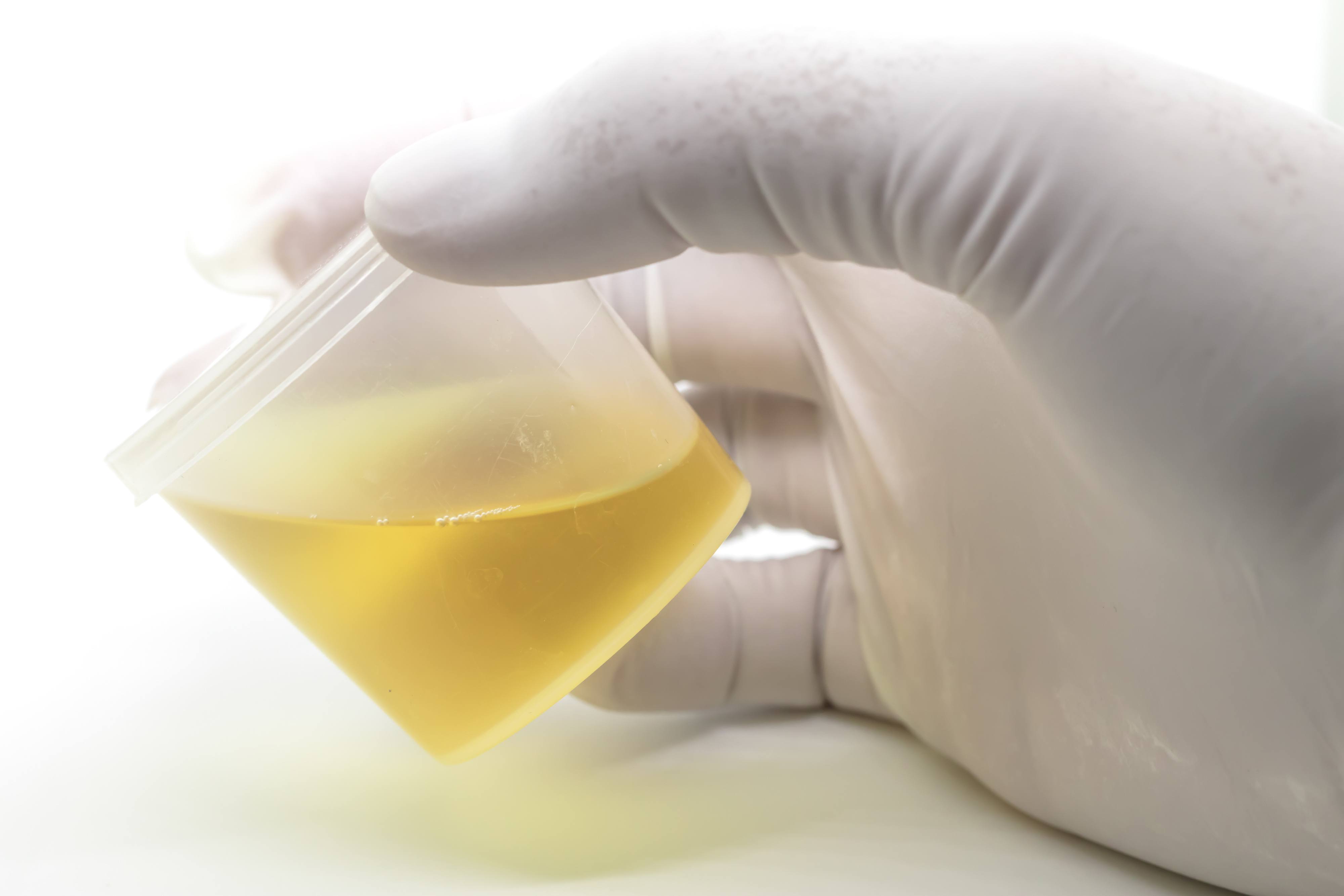 urine sample for urinalysis