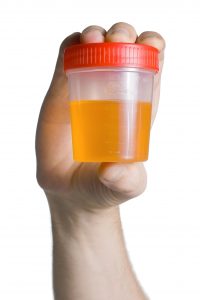 hand holding urine specimen