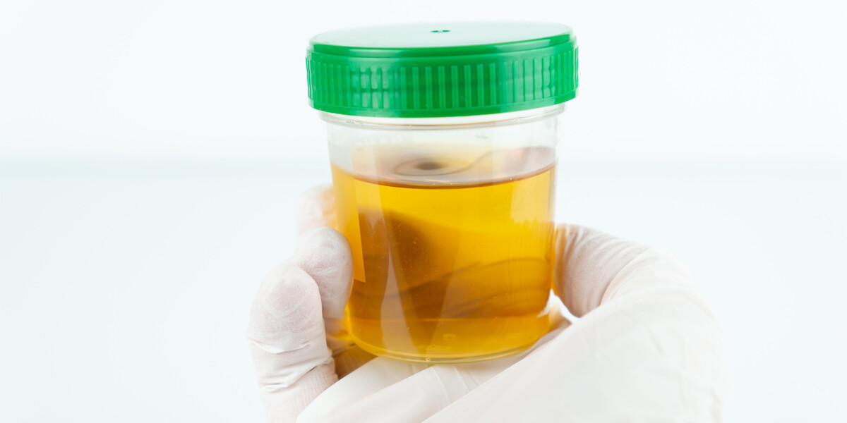 How Long Does Cocaine Last in Urine A Detailed Guide