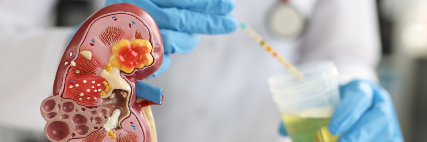 Nitrite in urine is sign of bacterial infection such as a UTI.