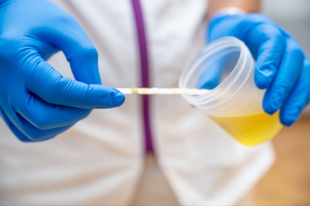 A nurse holding a urine sample container for medical urine analysis with a color strip