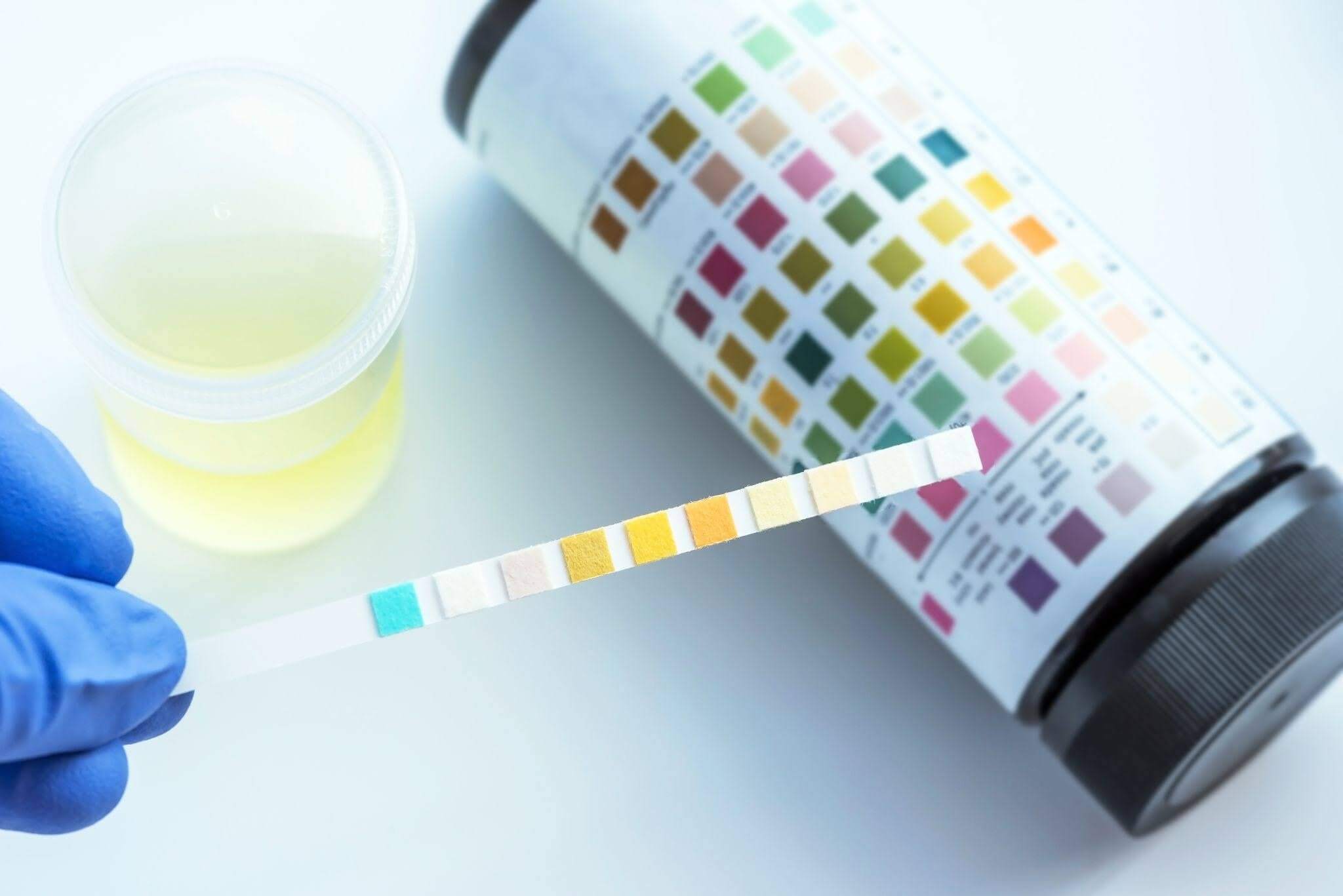 How Accurate Are At-Home Urine Test Strips?